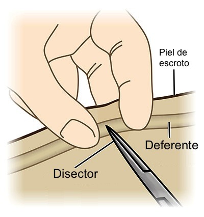 sin bisturi vasectomia