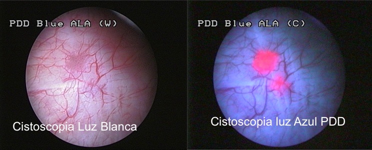 dianostico-ca-vejiga